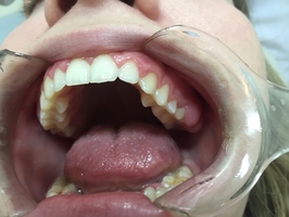Повече за  избелване на зъби 19
