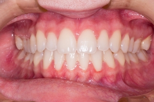 Вижте избелване на зъби 3