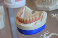 Качествени зъбни импланти цени 5