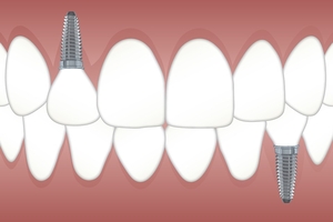 Our very best Dental Implants 13