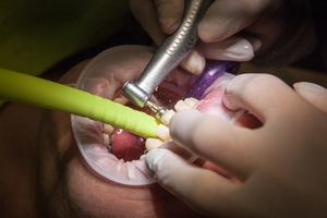 Look at Dental Implants 26