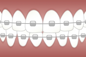 Information about Dental Implants 40